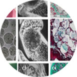 An injectable ready-to-use polysaccharide-based scaffold combined with hydroxyapatite tailored for oral bone defect reconstruction to be developed for 2 different indications An injectable ready-to-use polysaccharide-based scaffold combined with hydroxyapatite tailored for oral bone defect reconstruction to be developed for 2 different indications